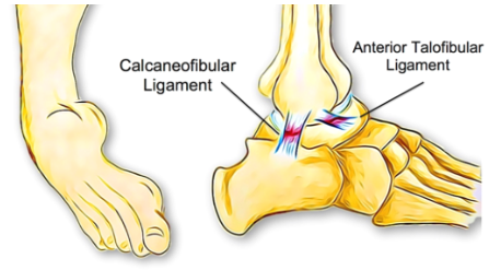 Ankle Sprains