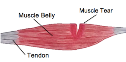 The Four Biggest Mistakes You Can Make After A Muscle Tear