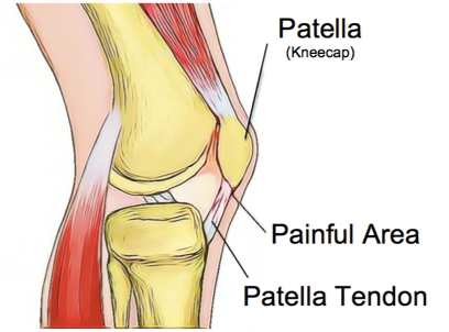 Patella Tendinopathy