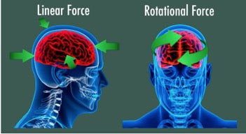 Physiotherapy Treatment for Concussions