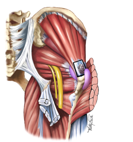 GLUTEAL TENDINOPATHY