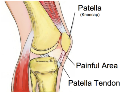 Patella Tendinopathy - Enhance Physiotherapy