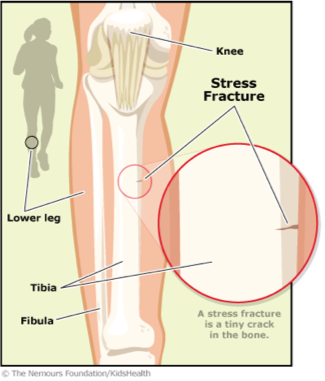 Stress Fractures (Bone Stress Injuries) - Enhance Physiotherapy